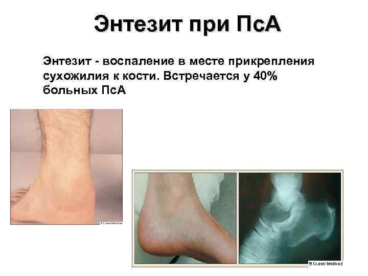   Энтезит при Пс. А Энтезит - воспаление в месте прикрепления сухожилия к
