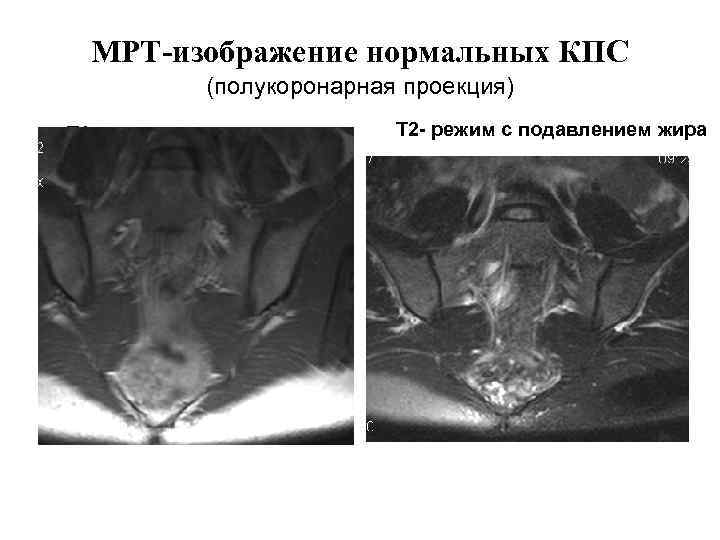 Мрт крестцово подвздошных сочленений режимы