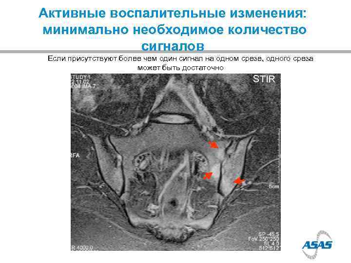 Активные воспалительные изменения: минимально необходимое количество   сигналов Если присутствуют более чем один