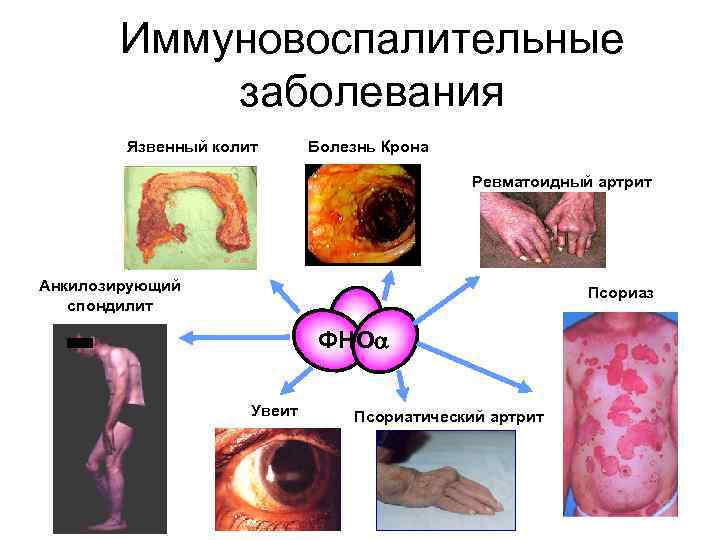   Иммуновоспалительные  заболевания   Язвенный колит  Болезнь Крона  