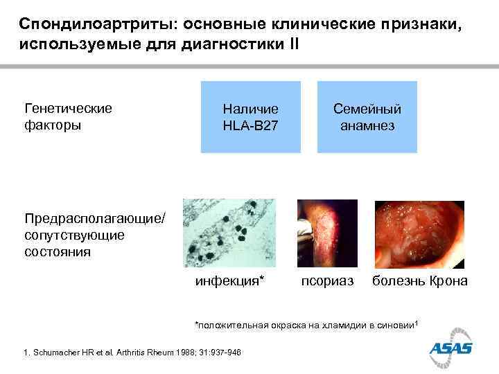 Спондилоартриты: основные клинические признаки, используемые для диагностики II  Генетические    Наличие