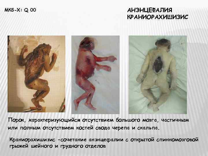 МКБ-Х: Q 00     АНЭНЦЕФАЛИЯ      