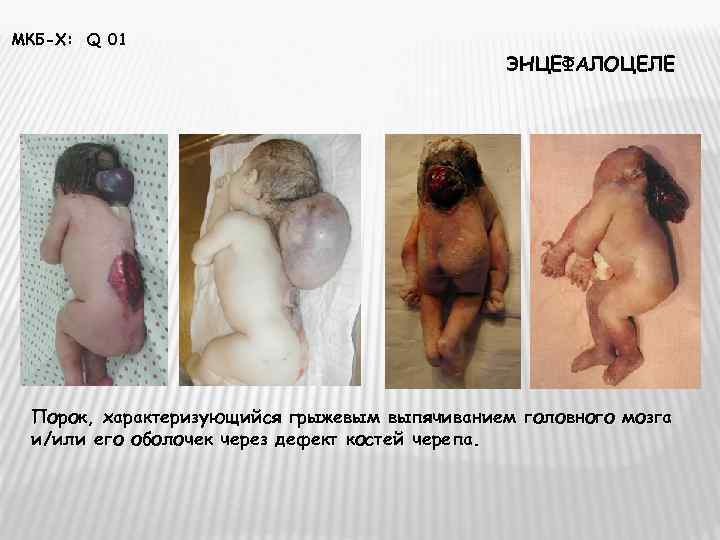МКБ-Х: Q 01    ЭНЦЕФАЛОЦЕЛЕ Порок, характеризующийся грыжевым выпячиванием головного мозга и/или