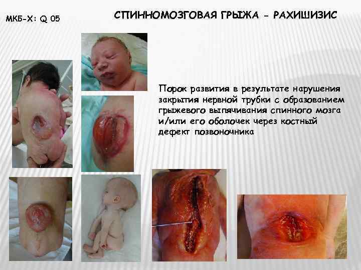 МКБ-Х: Q 05  СПИННОМОЗГОВАЯ ГРЫЖА - РАХИШИЗИС     Порок развития