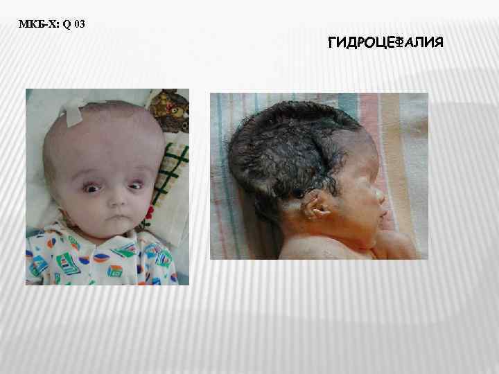 МКБ-Х: Q 03    ГИДРОЦЕФАЛИЯ 