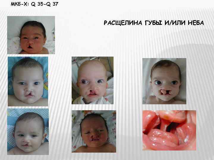 МКБ-Х: Q 35 -Q 37    РАСЩЕЛИНА ГУБЫ И/ИЛИ НЕБА 