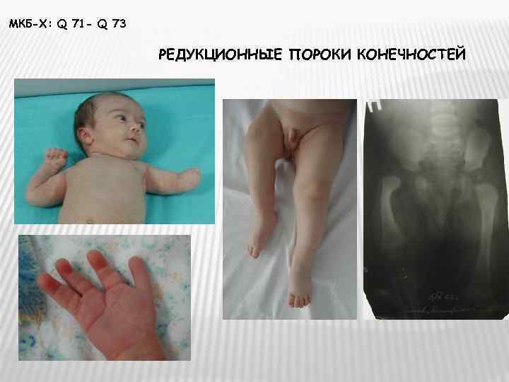 МКБ-Х: Q 71 - Q 73     РЕДУКЦИОННЫЕ ПОРОКИ КОНЕЧНОСТЕЙ 