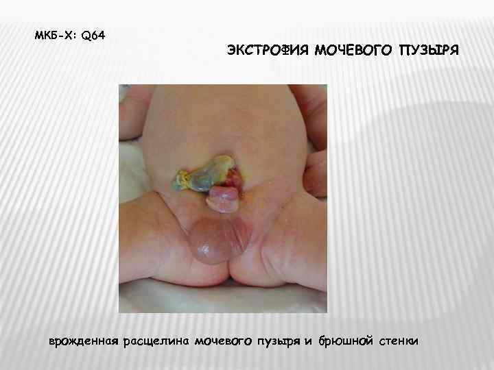МКБ-Х: Q 64      ЭКСТРОФИЯ МОЧЕВОГО ПУЗЫРЯ врожденная расщелина мочевого