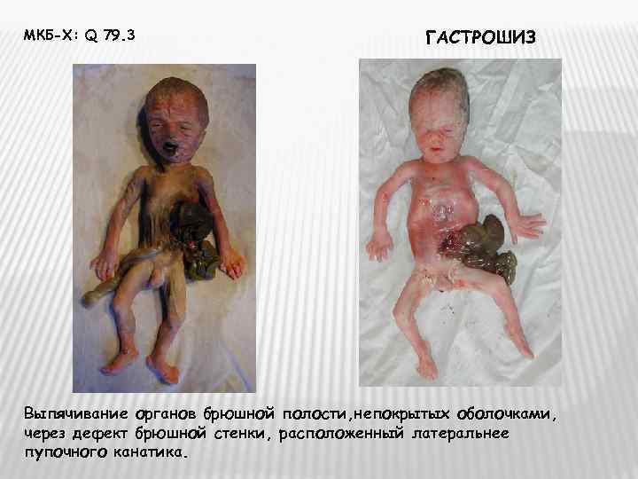 МКБ-Х: Q 79. 3     ГАСТРОШИЗ Выпячивание органов брюшной полости, непокрытых