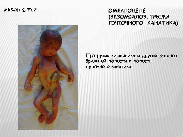 МКБ-Х: Q 79. 2  ОМФАЛОЦЕЛЕ     (ЭКЗОМФАЛОЗ, ГРЫЖА  