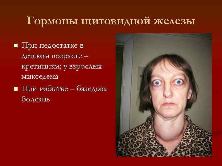 Гормоны щитовидной железы n  При недостатке в детском возрасте – кретинизм; у