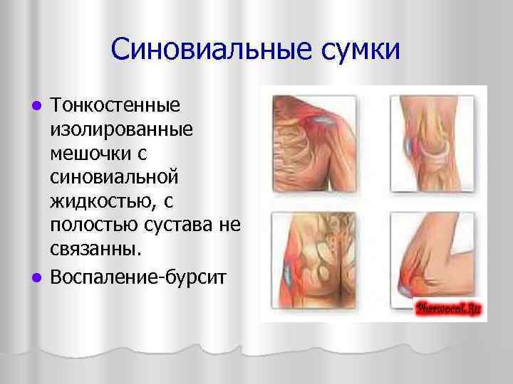   Синовиальные сумки l Тонкостенные  изолированные  мешочки с  синовиальной 