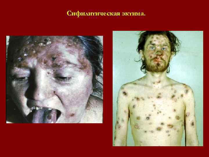 Сифилитическая эктима. Сифилитическая эктима.