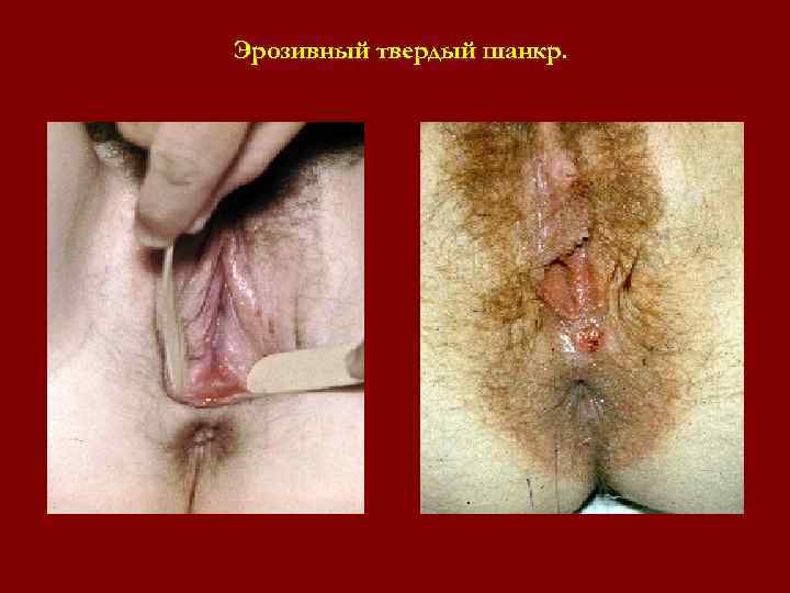 Эрозивный твердый шанкр. Эрозивный твердый шанкр.