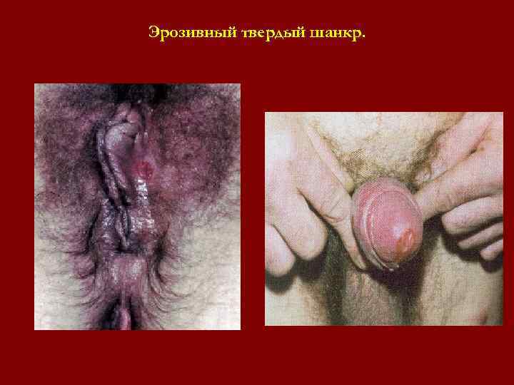 Эрозивный твердый шанкр. Эрозивный твердый шанкр.