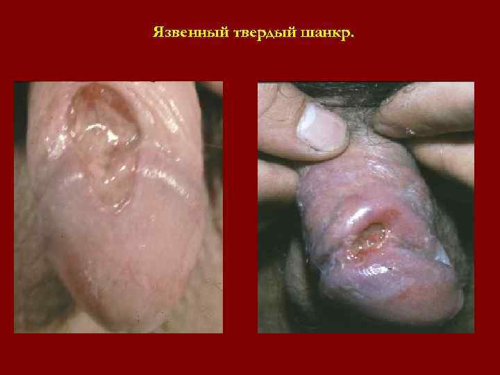 Язвенный твердый шанкр. Язвенный твердый шанкр.