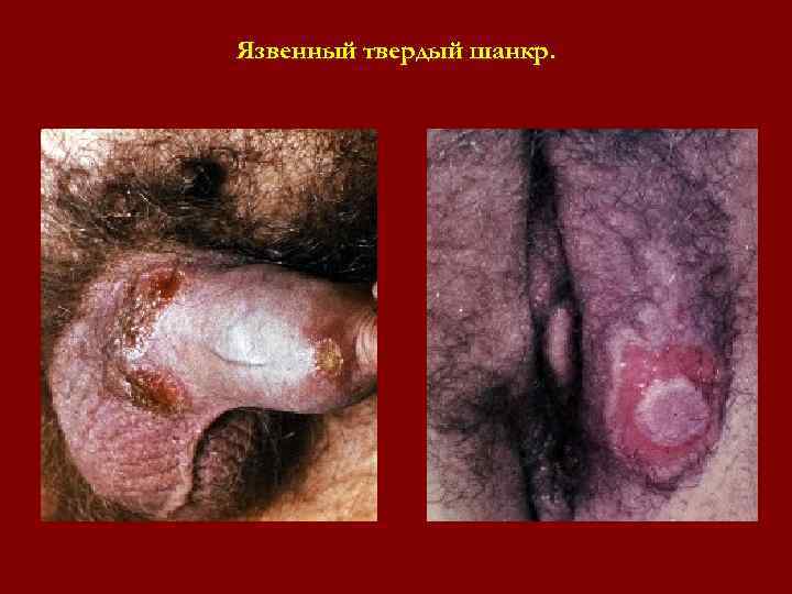 Язвенный твердый шанкр. Язвенный твердый шанкр.