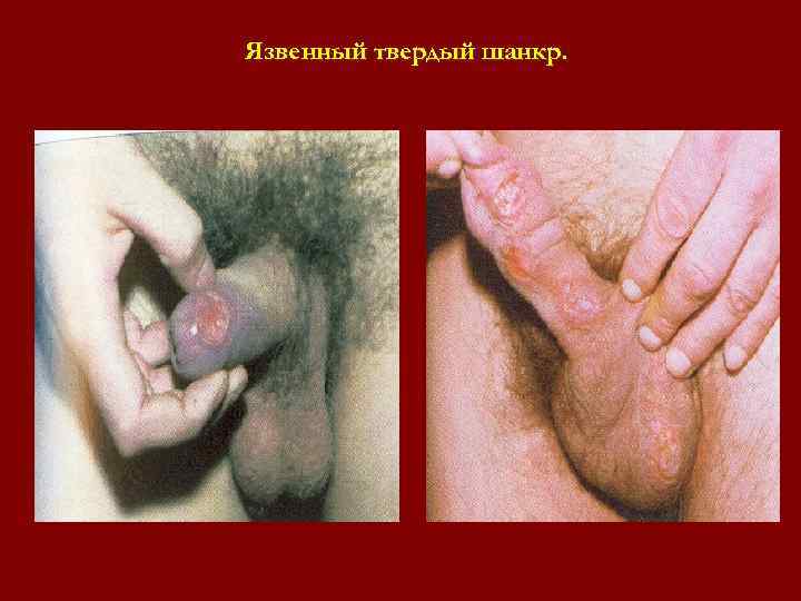 Язвенный твердый шанкр. Язвенный твердый шанкр.
