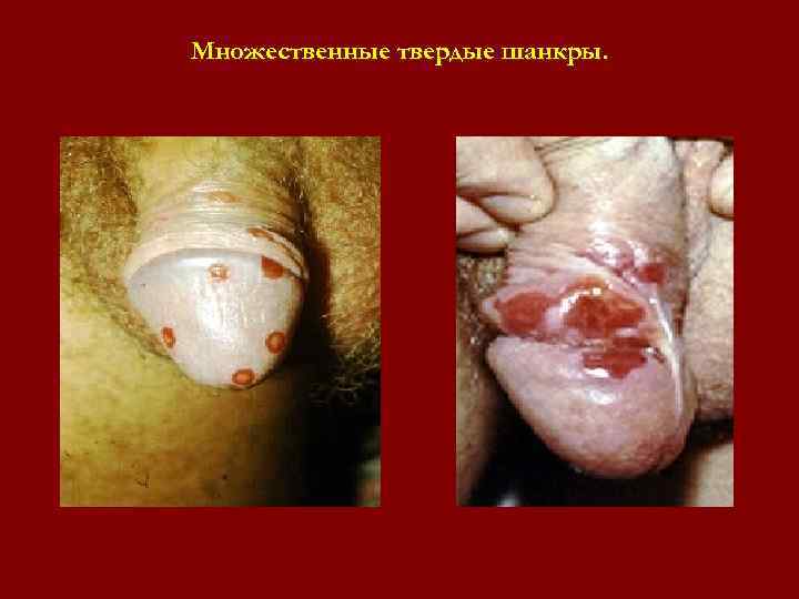 Множественные твердые шанкры. Множественные твердые шанкры.
