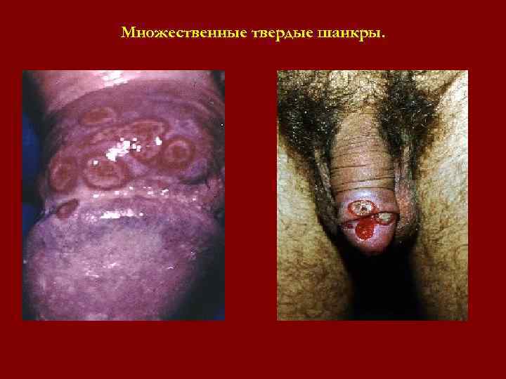 Множественные твердые шанкры. Множественные твердые шанкры.