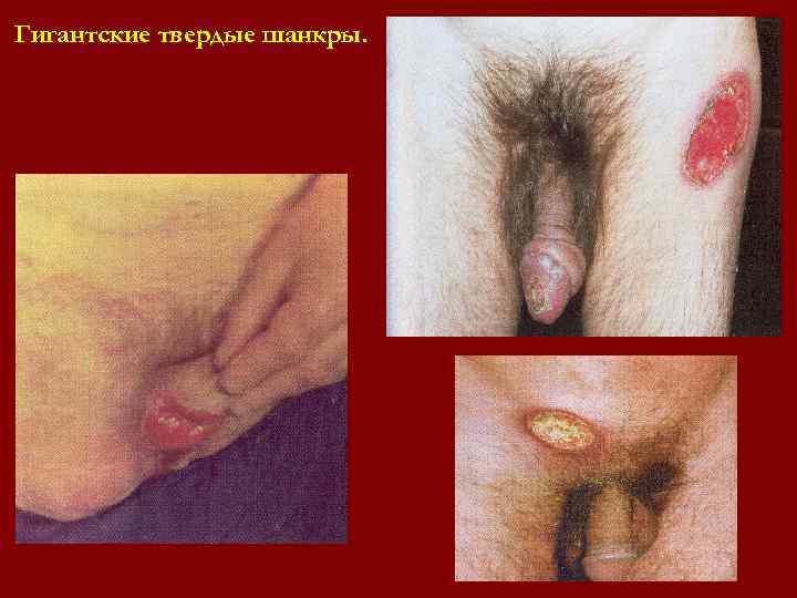 Гигантские твердые шанкры. Гигантские твердые шанкры.