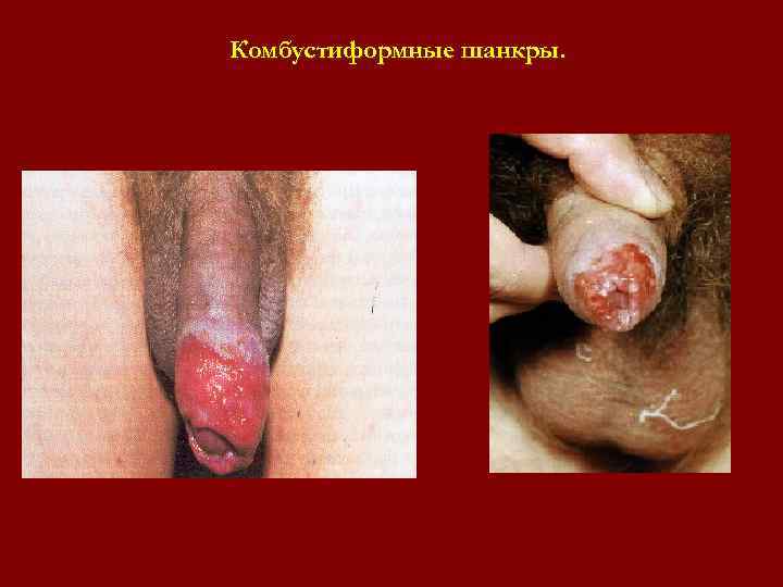 Комбустиформные шанкры. Комбустиформные шанкры.