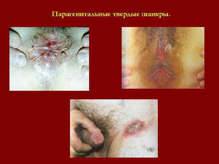 Парагенитальные твердые шанкры. Парагенитальные твердые шанкры.