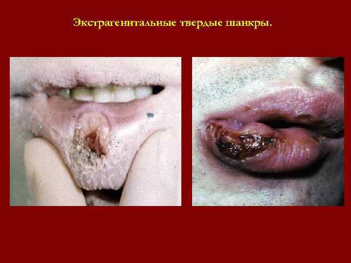 Экстрагенитальные твердые шанкры. Экстрагенитальные твердые шанкры.