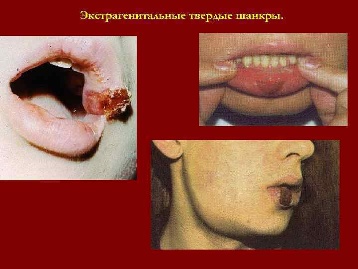 Экстрагенитальные твердые шанкры. Экстрагенитальные твердые шанкры.
