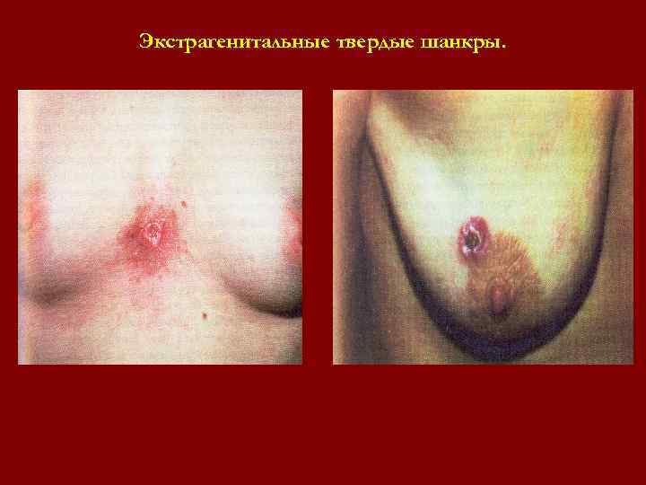 Экстрагенитальные твердые шанкры. Экстрагенитальные твердые шанкры.