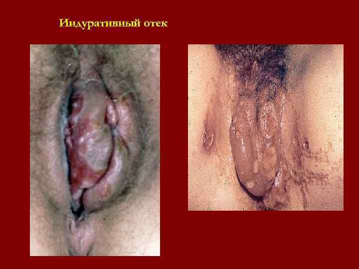 Индуративный отек Индуративный отек