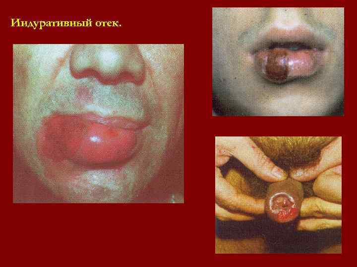 Индуративный отек. Индуративный отек.