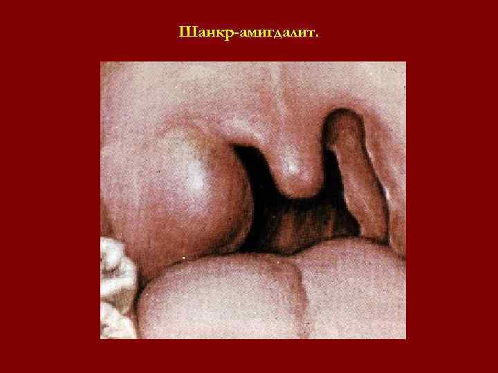 Шанкр-амигдалит. Шанкр-амигдалит.