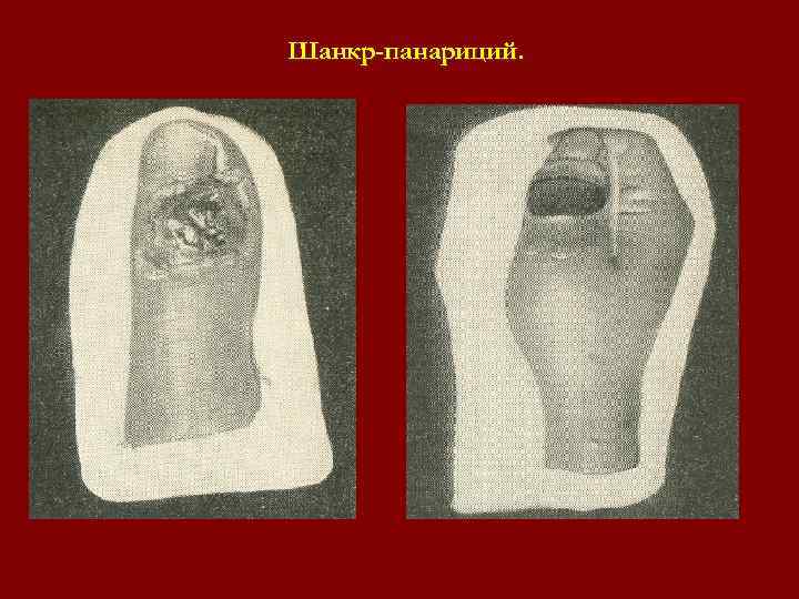 Шанкр-панариций. Шанкр-панариций.