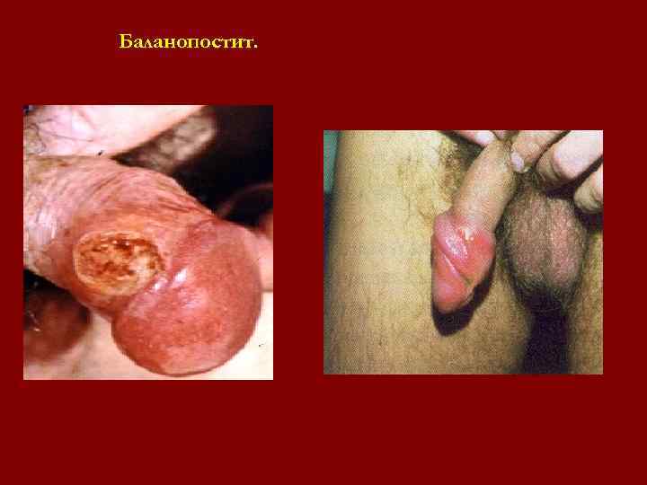 Баланопостит. Баланопостит.