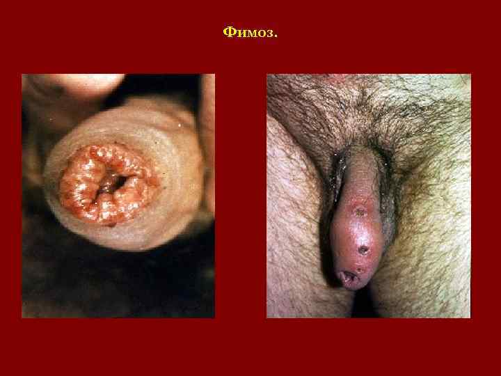 Фимоз. Фимоз.