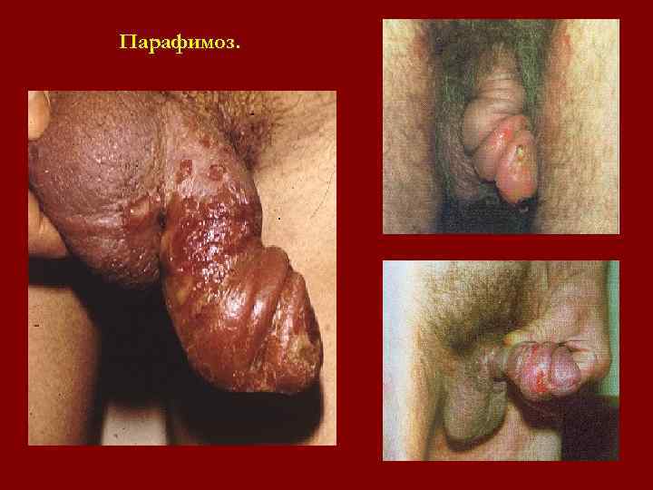Парафимоз. Парафимоз.