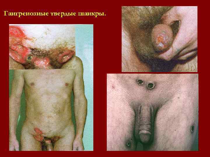 Гангренозные твердые шанкры. Гангренозные твердые шанкры.