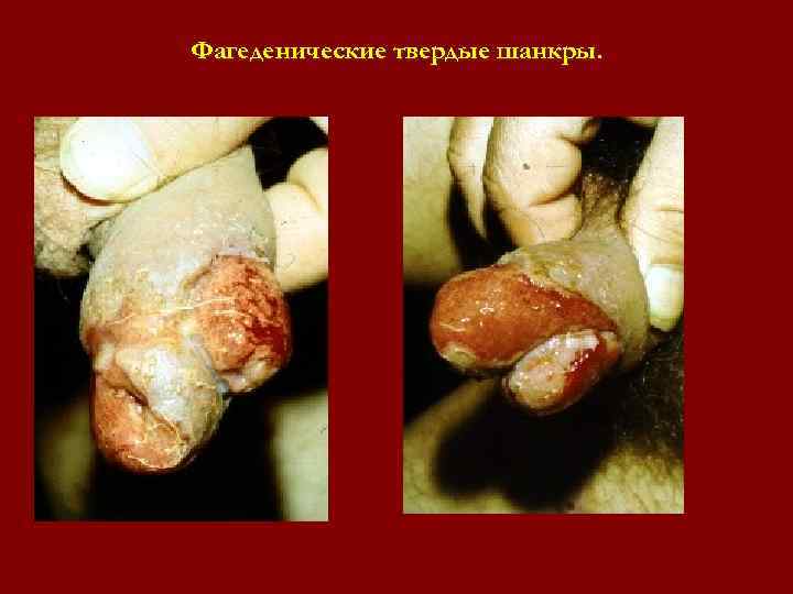 Фагеденические твердые шанкры. Фагеденические твердые шанкры.