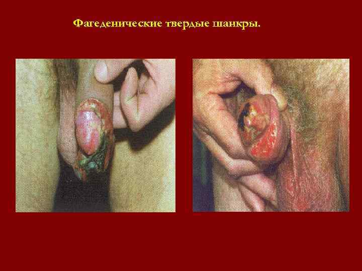 Фагеденические твердые шанкры. Фагеденические твердые шанкры.