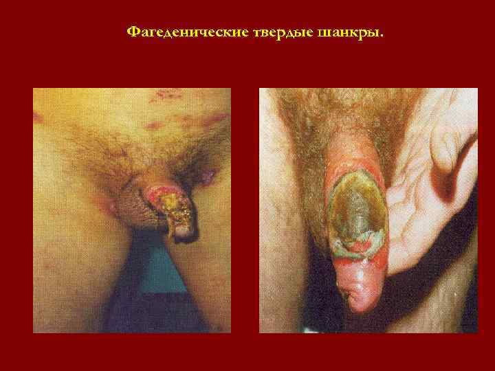 Фагеденические твердые шанкры. Фагеденические твердые шанкры.