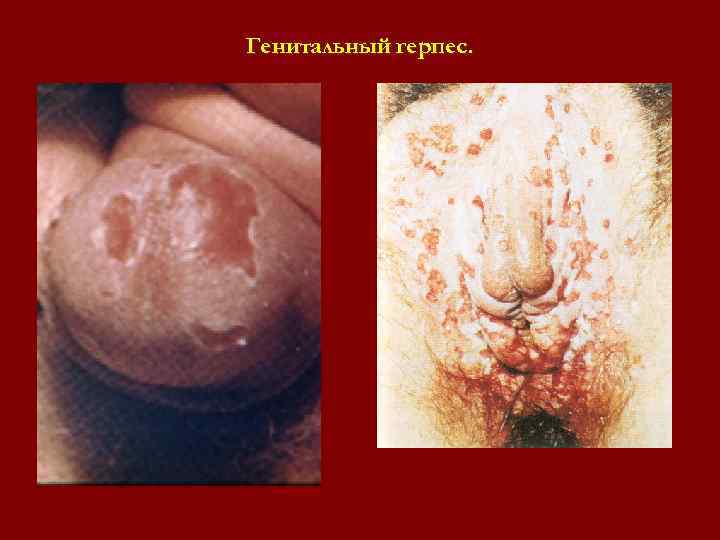 Генитальный герпес. Генитальный герпес.