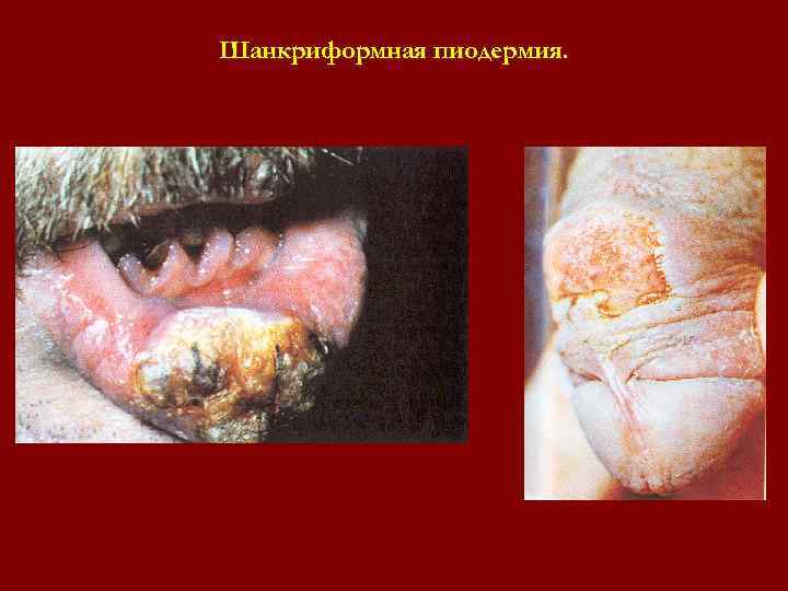 Шанкриформная пиодермия. Шанкриформная пиодермия.