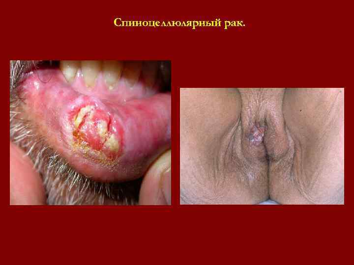 Спиноцеллюлярный рак. Спиноцеллюлярный рак.