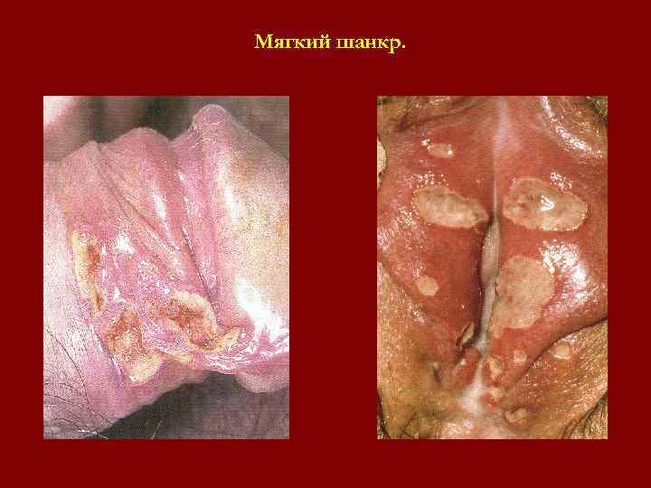 Мягкий шанкр. Мягкий шанкр.