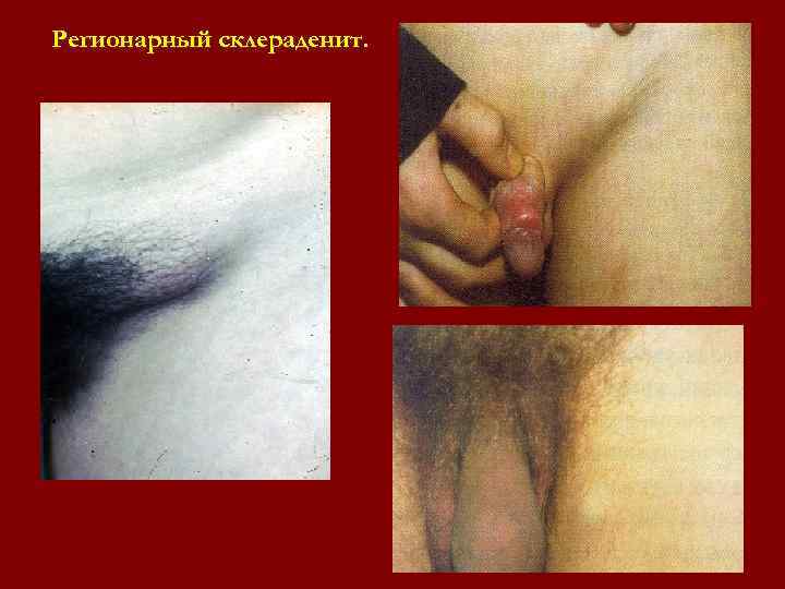 Регионарный склераденит. Регионарный склераденит.