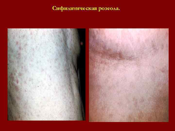 Сифилитическая розеола. Сифилитическая розеола.