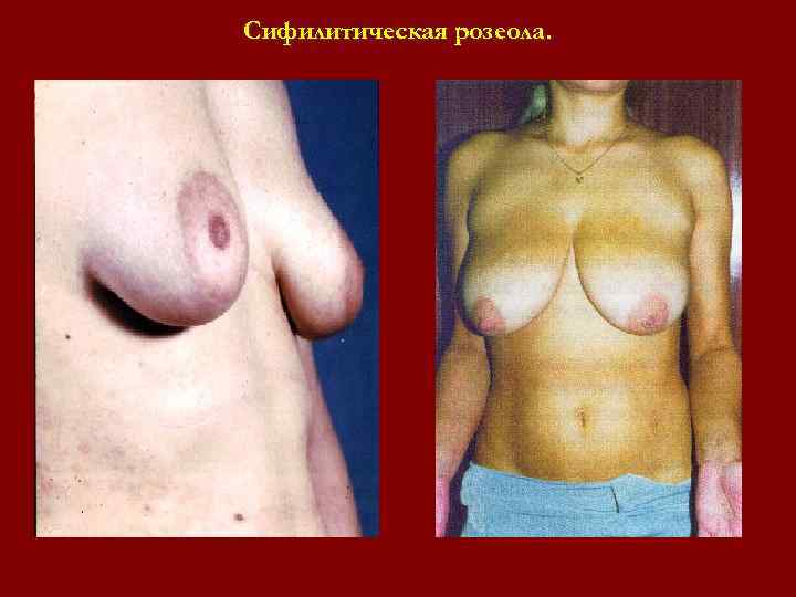 Сифилитическая розеола. Сифилитическая розеола.