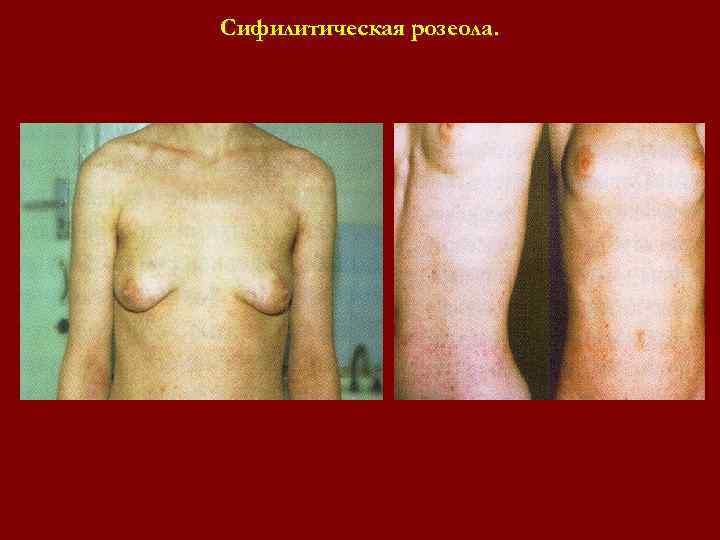 Сифилитическая розеола. Сифилитическая розеола.
