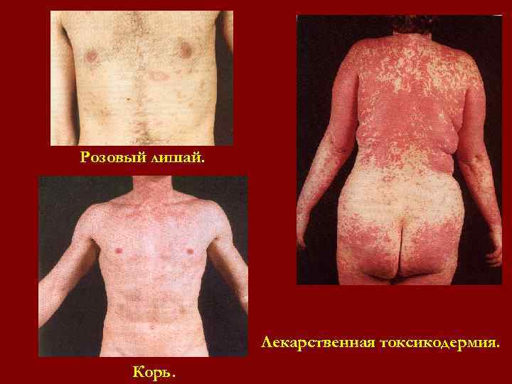Розовый лишай. Лекарственная токсикодермия. Корь. Розовый лишай. Лекарственная токсикодермия. Корь.